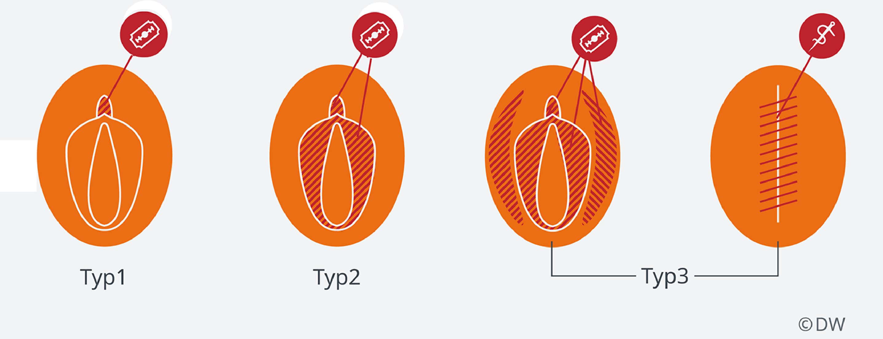 FGM Illustration